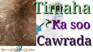 Daawo. Timaha Ka Soo Baxa Xubnaha Taranka Dushooda