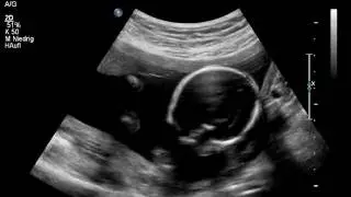 Baby Ultraschall 20. SSW - it's a girl :) II