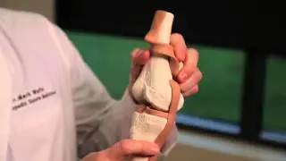 Dr. Mark Maffet performs Meniscus Surgery