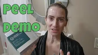 Soonsu Shining TCA Peel Demo & All About Different Skin Peels, How to, and Benefits