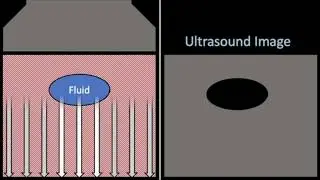 Posterior acoustic enhancement on ultrasound