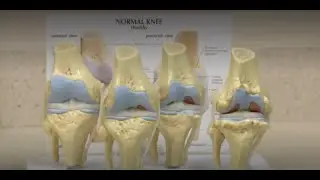 How gender plays a role in ACL injuries