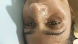 SUPINE ROLL TEST - (APOGEOTROPIC POSITIONAL NYSTAGMUS)