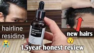 &ldquo;Bare Anatomy Advanced Hair Growth Serum Review &ndash; 1.5 Years Results & Honest Opinion&rdquo;