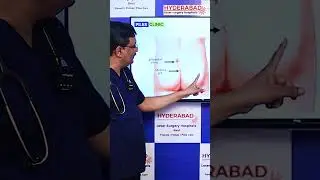 Causes & Symptoms of Pilonidal Sinus || Hyderabad Laser Piles Surgery