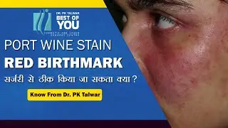 Can Port Wine Stain (Red Birthmarks) be Removed by Surgery | Dr. PK Talwar
