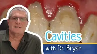 Sugar and Cavities - What is the relationship between the two?