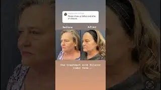 Ellacor non-surgical tightening and lip lift #liplift #antiaging #lipflip