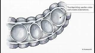 Ischemic Colitis: Understanding the Sudden Belly Pain and Recovery