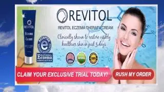 over counter eczema cream