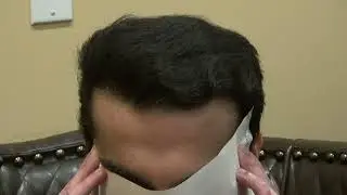 Real Hair Transplant Results! 🏆 Thick, Natural, and Permanent Growth