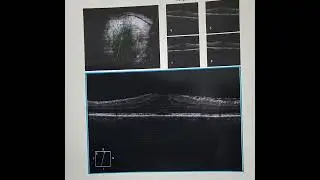 Loss of foveal contour & macular Edema in posterior layers