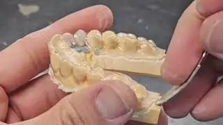 Make ESSIX retainer for #10 and #11