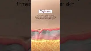 micro needling with radiofrequency technology