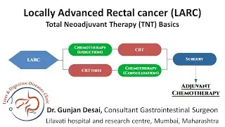 Locally advanced rectal cancer & total neoadjuvant therapy - Induction vs consolidation chemotherapy
