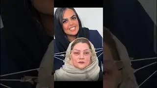 face lift #shorts #viralvideo #trending #facelift #beauty #fyp #music #song#ytshorts #love #fashion