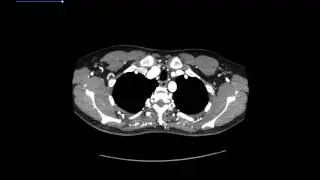 STR Cardiothoracic Web Case Conference 5/11/2017