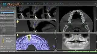 Single Implant Planning Masterclass | Surgical Guide & Screw-Retained Restoration Workflow
