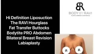 Amazing Results After Breast Revision, Liposuction and Fat Transfer to the Buttocks