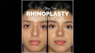 Incredible Results from Rhinoplasty: Before & After Reveal | Dr. Anthony Corrado