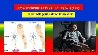 AMYOTROPHIC LATERAL SCLEROSIS (ALS) Explained | Causes, Types, Symptoms, Diagnosis & Treatment