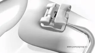 QuicKlear &mdash; открывание брекетов с гингивальной стороны