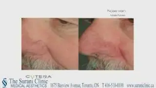 Facial Veins and Sun Spots Removal (Toronto, Ontario)