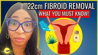 Can a 22 cm Fibroid Be Removed Without Surgery? A Critical Guide.