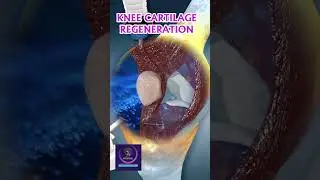 Knee Cartilage Regeneration - Osteoarthritis Treatment