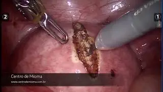 Cirurgia de Miomectomia Robótica - Centro de Mioma