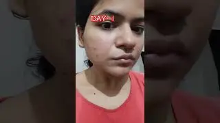 tried out Derma co 2% salicylic acid on my hormonal breakouts (results).Part-2#unsponsored review