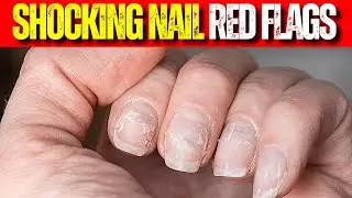 Shocking Health Warnings Your Nails Are Trying to Tell You