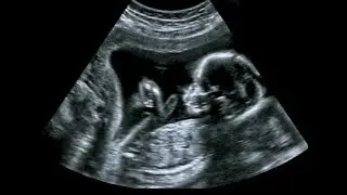 Was A Brain Injury During Delivery The Cause Of Your Baby&rsquo;s Cerebral Palsy Diagnosis?