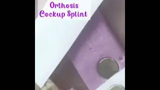 Cockup splint for wrist drop....for correction of wrist drop deformity #orthotics #orthosis #pando