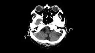 TCE, contus&atilde;o cerebral, hematoma subdural na tenda cerebelar, SHA, higroma