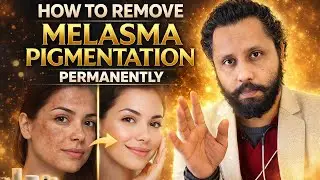 How to Cure Melasma / Pigmentation Permanentely. Dr Prateek chauhan