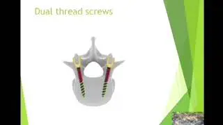 Transpedicular Screw Fixation Technique | Spine Fixation | Spine Trauma