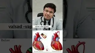 Bypass surgery:-How long do  grafts last..