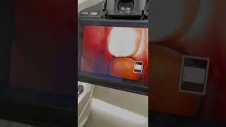 New tooth on one day , Cerec Sirona scan a cad , CAD CAM #teeth #dentist #dental #dentistry