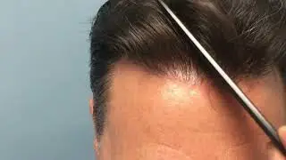 ⭐⭐ ⭐⭐⭐Case #162 - &Delta;&epsilon;ί&tau;&epsilon; &tau;&omicron; &alpha;&pi;&omicron;&tau;έ&lambda;&epsilon;&sigma;&mu;&alpha; &mu;&epsilon; 2500 FUs - Anastasakis Hair Clinic
