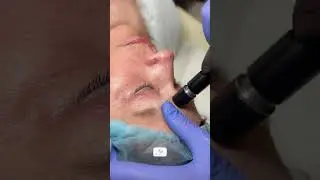 Opus Plasma RF: Enhancing Results After Blepharoplasty