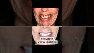 😲 Full Mouth Dental Implant Transformation | All-on-4 Smile Reveal!