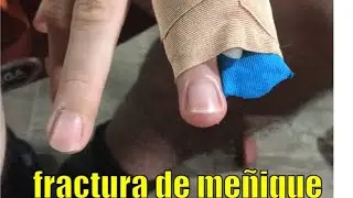 Fractura de meñique - cambio del férula - estiramientos y movimientos