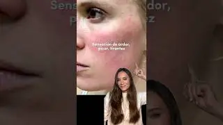 C&oacute;mo se ve y se siente la #rosacea #dermatologist #skincare