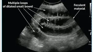 distended/content filled bowel loops showing sluggish movements in lower abdomen. #dilatedbowel.
