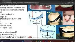 partial denture 7 (direct retainer)