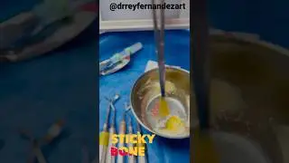 UNCONVENTIONAL STICKY BONE. By @drreyfernandezart #prf  #rpf #rog #gbr #oralsurgery