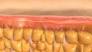 VelaShape II Fat loss & anti-Cellulite treatments at Wellbeing Clinic in Dubai