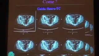 Lesioni Pseudotumorali. Biopsie osse: come e quando. Eugenio Genovese