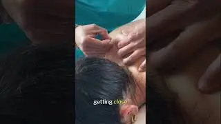 Лечение распространённой боли в верхней части спины с помощью иглоукалывания! ЧАСТЬ 2